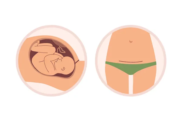 Cesarean Delivery